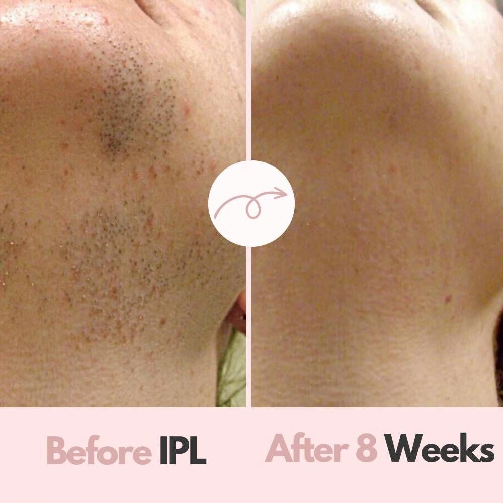 YAPAFA IPL-LAZER HAIR REMOVER Device