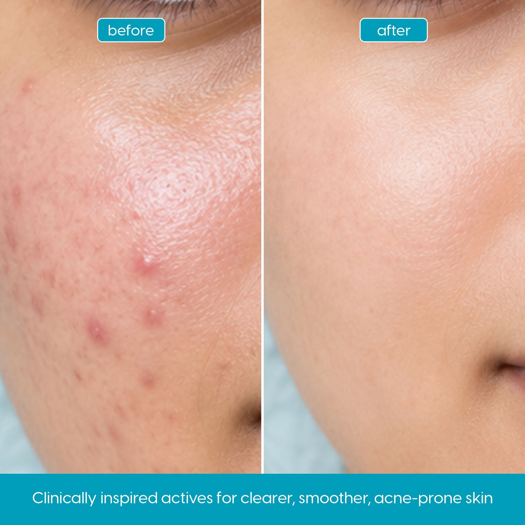 Salicylic Acid 2% Serum – Pore Clearing Treatment for Oily, Acne-Prone Skin