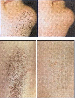 YAPAFA IPL-LAZER HAIR REMOVER Device